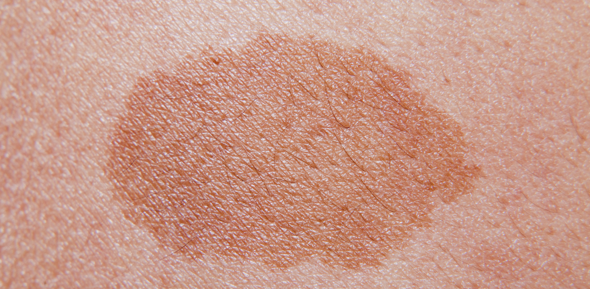 chloasma treatment, hong kong